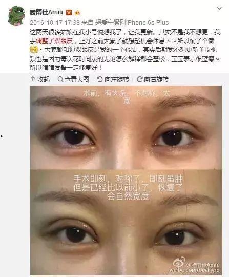 割双眼皮的网红,揭秘双眼皮的魅力与改变